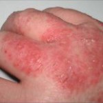 Diseases that Cause Bumps On Skin