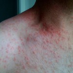 Diseases that Cause Bumps On Skin