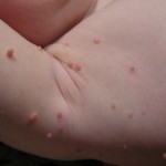 Diseases That Cause Bumps On Skin