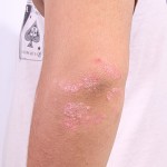 Diseases that Cause Bumps On Skin