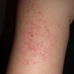 what is keratosis pilaris