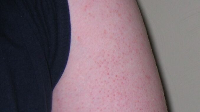 what causes keratosis pilaris