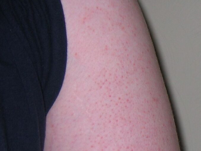 How To Get Rid Of Keratosis Pilaris With Essential Oils | Keratosis