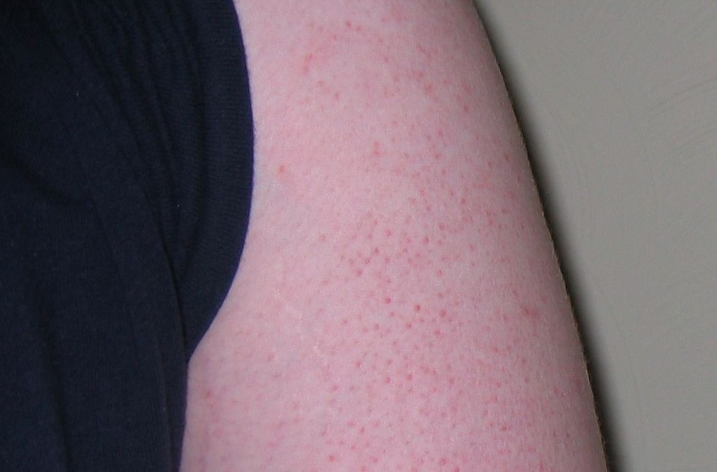 What Causes Keratosis Pilaris? | Keratosis Pilaris Help