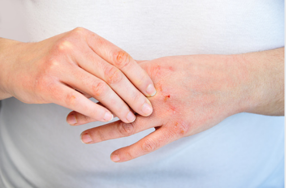 hand eczema treatment