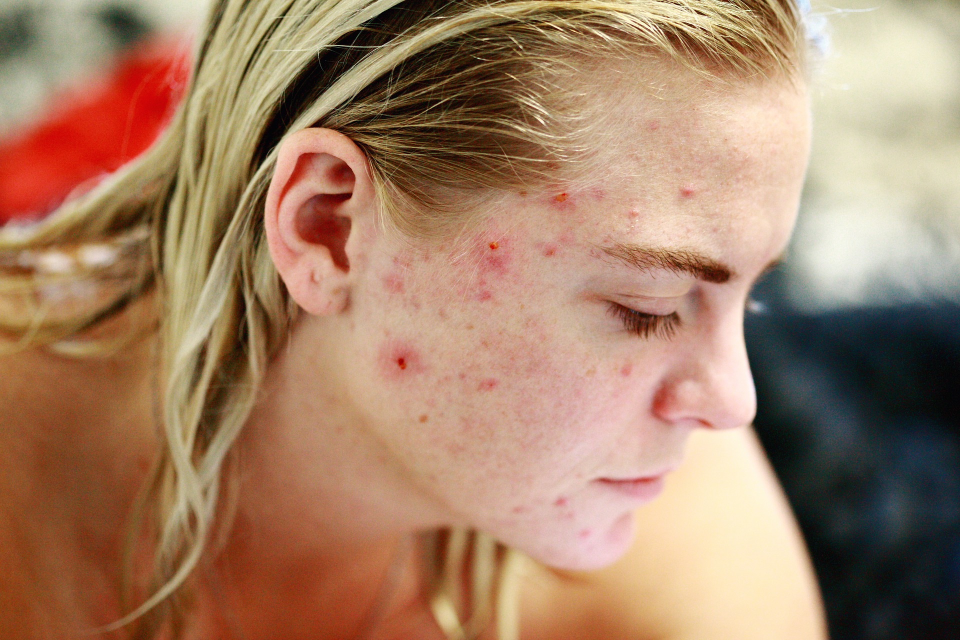 keratosis-pilaris-on-face-how-to-deal-with-it-keratosis-pilaris-help